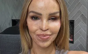 "So Cowardly": Katie Piper Announces 'End Of The Road' Health Update 16 Years After Acid Attack