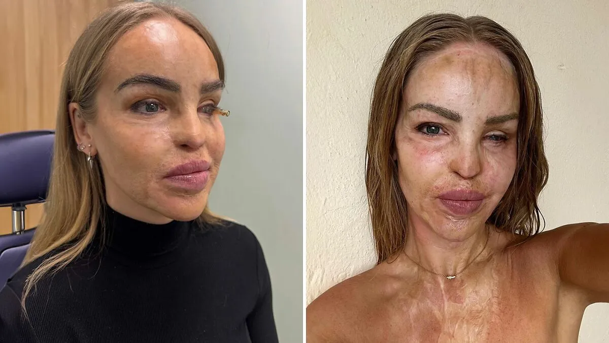 "So Cowardly": Katie Piper Announces 'End Of The Road' Health Update 16 Years After Acid Attack