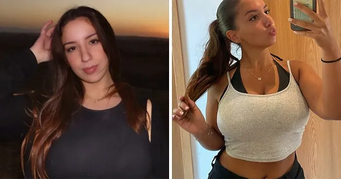 "Always In Pain": Woman’s 30J Breast Reduction Plea Rejected, Faces Harassment