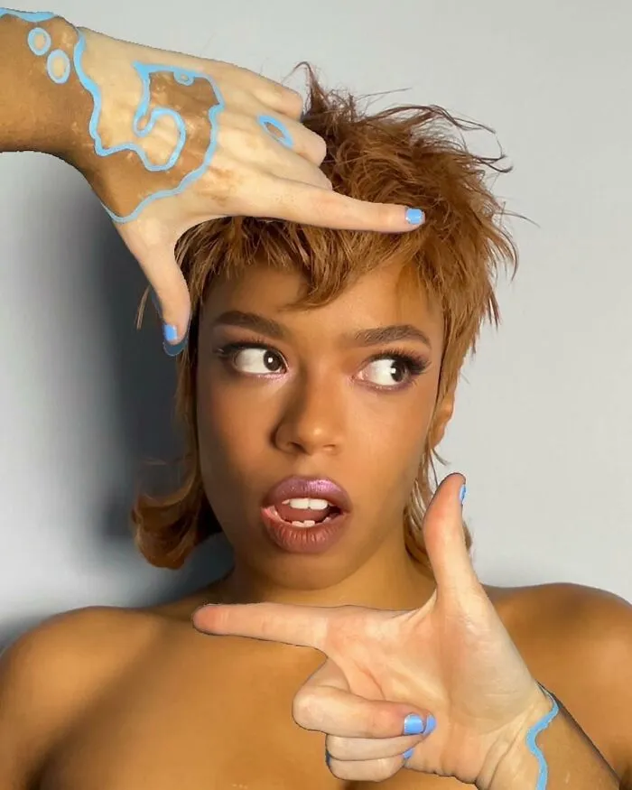 Dancer-Turned-Artist Amara Aleman Turns Her Vitiligo Into Vibrant Body Art (20 Pics)