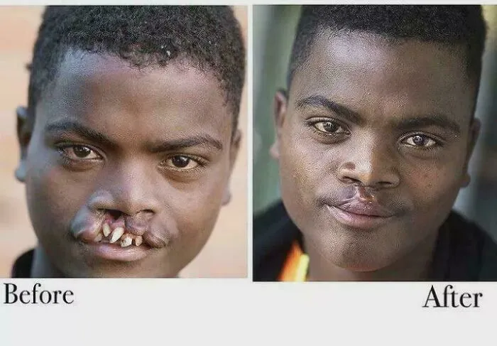 Antes y después de una cirugía maxilofacial extensa