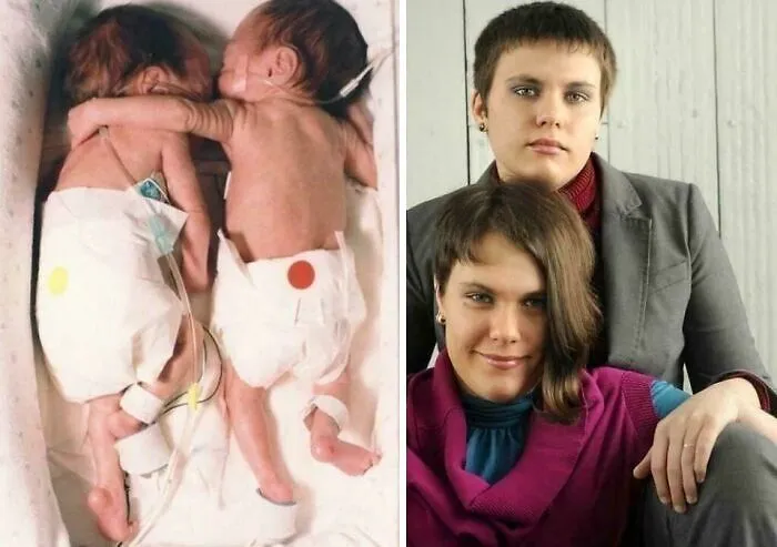In 1995, A Pair Of Twins, Kyrie And Brielle Jackson, Was Born 12 Weeks Premature. Each Weighed Only About 2 Pounds. One Of Them Was Not Expected To Survive