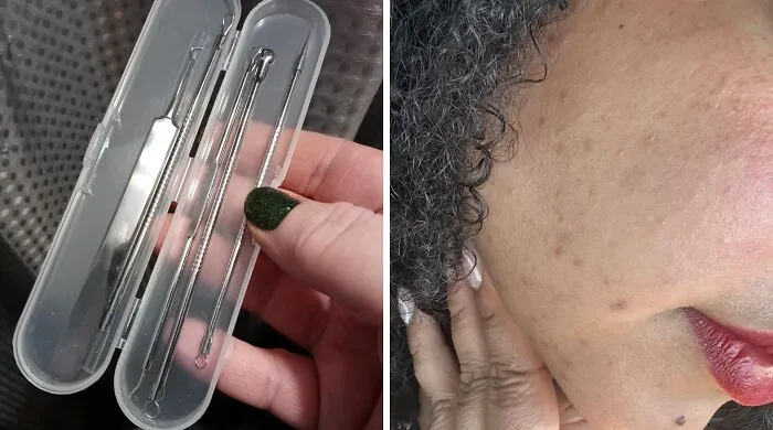 Don't Let Zits Get In The Way Of Your Zen— This <a Style="Display:inline;" Href="Https://Www.amazon.com/Blackhead-Comedone-Extractor-Professional-Stainless/Dp/B089k6pmtd?ie=utf8&linkcode=ll1&tag=bpgecko-20&linkid=692290c12e071c0214627d129509fd1f&language=en_us&ref_=as_li_ss_tl" Target="_blank"><span Style="Font: Inherit; Color: #d74b1f;"> Pimple Removing Kit</Span> Is Like A Dermatologist In A Box (But Way More Affordable And Less Judgmental)
