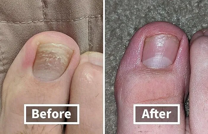 Toe-Tally Transformed: Check Out This Before-And-After Using <a Style="Display:inline;" Href="Https://Www.amazon.com/Dp/B007adol28?ascsubtag=6240515%2c13%2c28%2cd%2c0%2c0%2c0%2c900%3a2%3b974%3a3%3b1125%3a1%3b1242%3a1%2c18167286%2c0%2c0%2cgoogle&btn_ref=srctok-Acb4de7c825d0ff1&th=1&linkcode=ll1&tag=bpwombat-20&linkid=977979d2543944ca46cf75961b89144b&language=en_us&ref_=as_li_ss_tl" Target="_blank"><span Style="Font: Inherit; Color: #d74b1f;"> Kerasal Nail Renewer </Span>, The Results Definitely Aren't Pedestrian