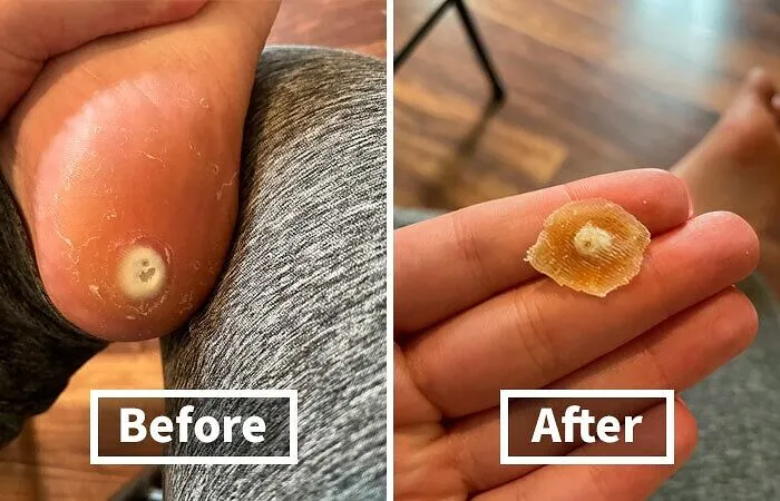 This Is *corny* But <a Style="Display:inline;" Href="Https://Www.amazon.com/Remover-Corn-Toe-Corn-Callus-Removal-Large/Dp/B0d7l2c9vj?ie=utf8&th=1&linkcode=ll1&tag=bpwombat-20&linkid=bfab226865d4d468bb2aef2667ef4ca9&language=en_us&ref_=as_li_ss_tl" Target="_blank"><span Style="Font: Inherit; Color: #d74b1f;">corn Remover Pads </Span> Totally Worked, Bye Felicia