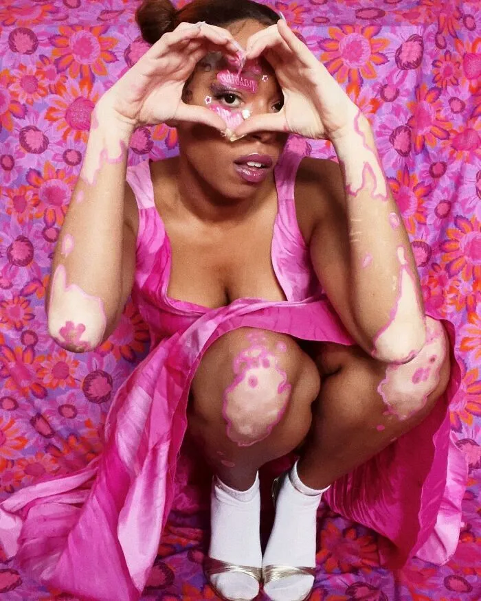 Dancer-Turned-Artist Amara Aleman Turns Her Vitiligo Into Vibrant Body Art (20 Pics)