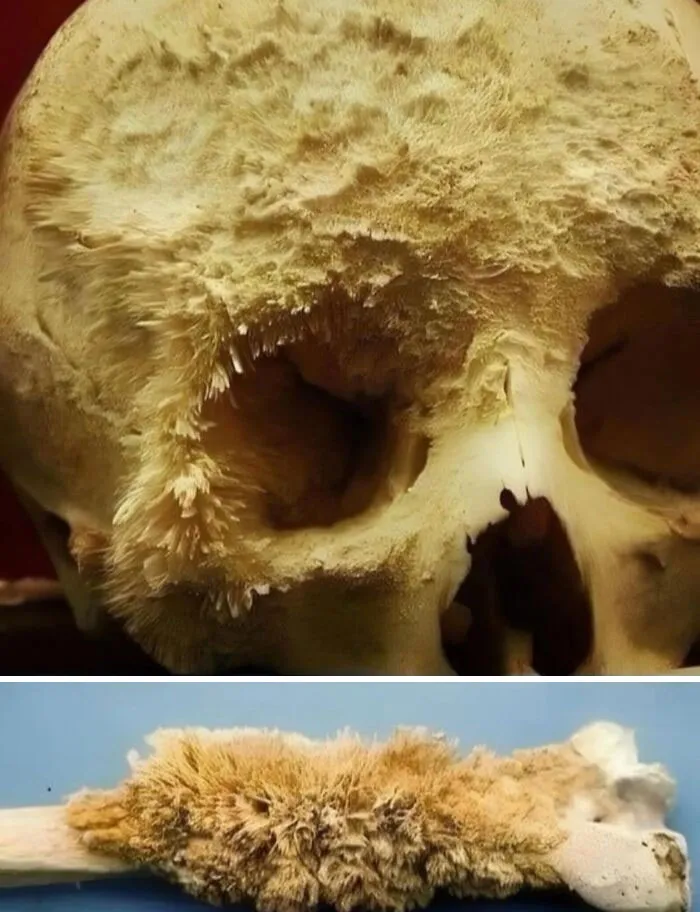 Human Skull With Stage 1 Bone Cancer. Credit : Prinoth-1