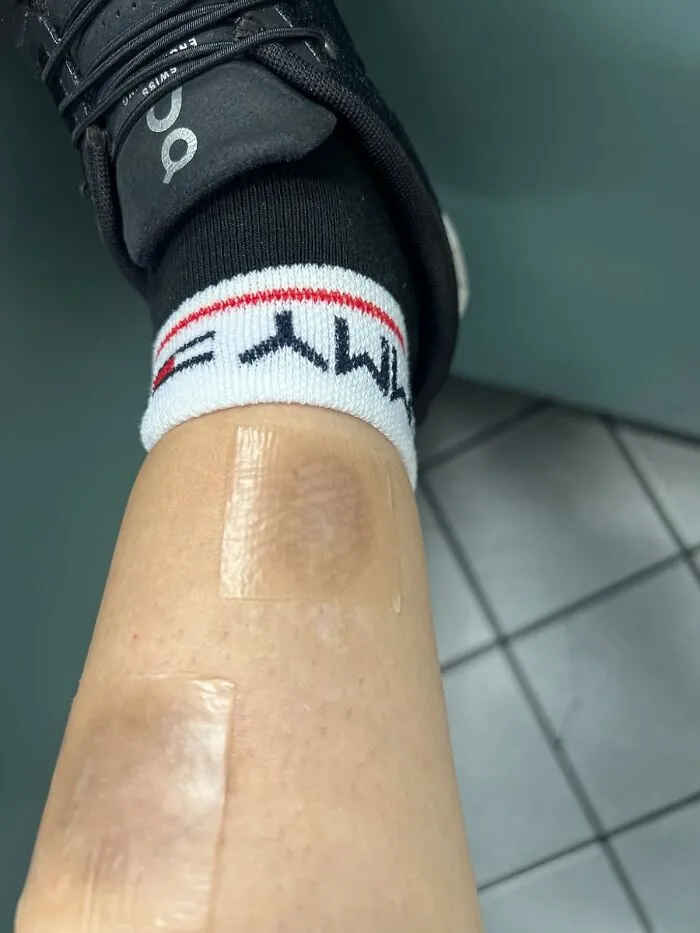 Fade, Flatten, And Minimize Scars With These Innovative <a Style="Display:inline;" Href="Https://Www.amazon.com/Silicone-Surgical-Removal-C-Section-Roll-1-5m/Dp/B0d8j5sv3c?ie=utf8&th=1&linkcode=ll1&tag=bpkoala-20&linkid=95f6d38b093cd3beab2993ada490d66d&language=en_us&ref_=as_li_ss_tl" Target="_blank"><span Style="Font: Inherit; Color: #d74b1f;"> Silicone Scar Sheets </Span> That Soften, Smooth, And Rejuvenate Damaged Skin, Helping To Erase The Appearance Of Scars And Reveal A More Radiant, Confident You