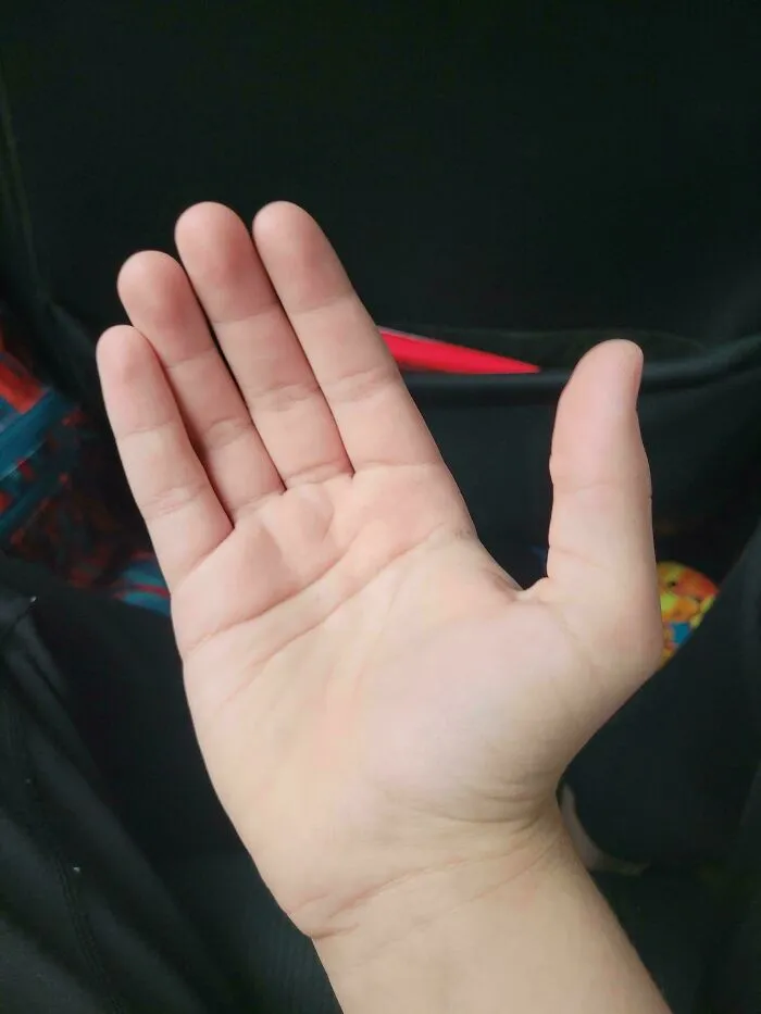 Some People Are Born With Six Fingers Dure To A Rare Genertic Trait Called Polydactyly. I Am Not One Of Those People