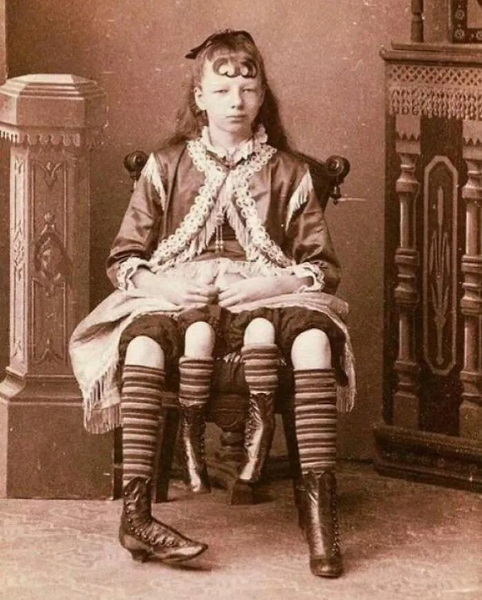 Fotografiada en 1880, Myrtle Corbin nació como una dipigo, con dos pelvis funcionales independientes y cuatro piernas. Se casó y tuvo cinco hijos.