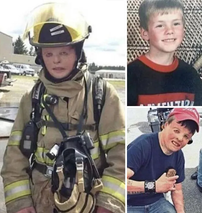Despite Suffering Severe Burns As A Child, This Man Went On To Become A Firefighter