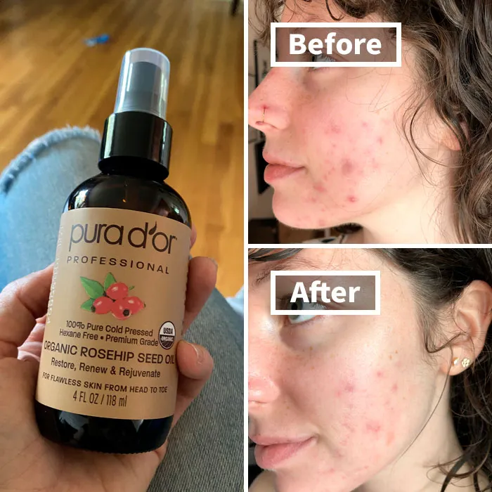 Organic rosehip seed oil bottle, with before and after skin improvement results from using beauty products.
