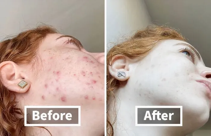 Blast Away Breakouts And Blemishes With The <a Style="Display:inline;" Href="Https://Www.amazon.com/Panoxyl-Foaming-Peroxide-Strength-Antimicrobial/Dp/B081kl2qyj?ie=utf8&th=1&linkcode=ll1&tag=bplemon-20&linkid=4072d9bc379dc2bc645cf196cc22e2d3&language=en_us&ref_=as_li_ss_tl" Target="_blank"><span Style="Font: Inherit; Color: #d74b1f;"> Foaming Acne Face Wash</Span>, A Powerful Cleanser That Leaves Your Complexion Clear, Calm, And Totally In Control