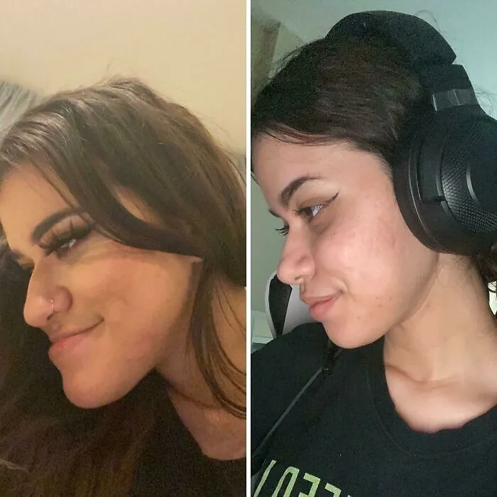 Antes VS 6 semanas después de hacerme la doble operación de mandíbula