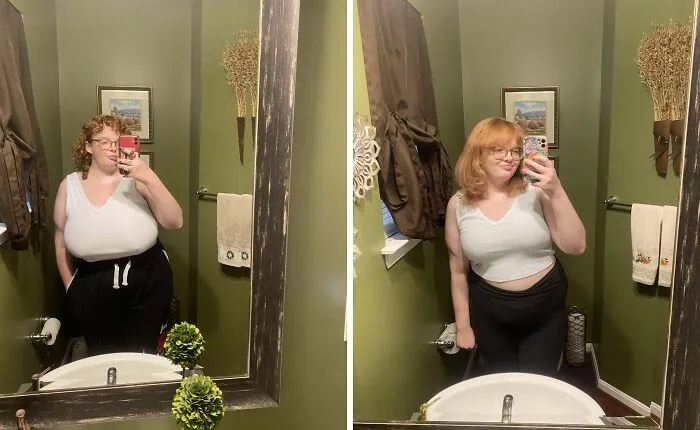 1 semana tras la operación y soy libre. Me han quitado 1 kilo de cada lado