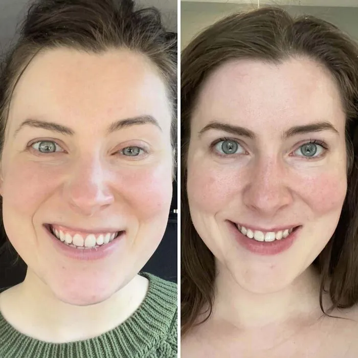 Botox para la parálisis de Bell