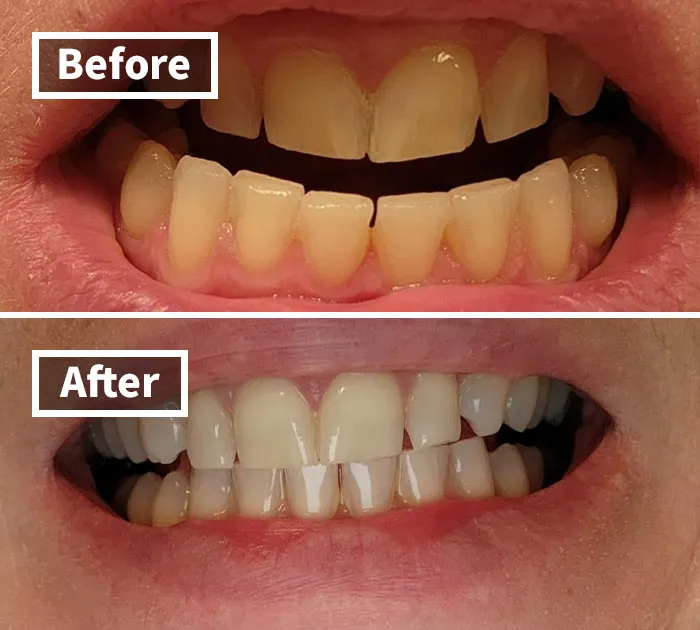 Get Ready To Flash That Pearly White Smile With This <a Style="Display:inline;" Href="Https://Www.amazon.com/Dp/B082x2gsgj?ascsubtag=7633336%2c3%2c34%2cd%2c0%2c0%2cbf-Web-Hf%2c900%3a2%3b974%3a2%3b1125%3a1%2c44097439%2c0%2c0%2cgoogle&th=1&linkcode=ll1&tag=bpelk-20&linkid=d6dc57905617749f515d2ca324731cb4&language=en_us&ref_=as_li_ss_tl" Target="_blank"><span Style="Font: Inherit; Color: #d74b1f;"> Teeth Whitening Pen</Span> - It's Like A Coffee-Stain-Erasing Magic Wand For Your Teeth!