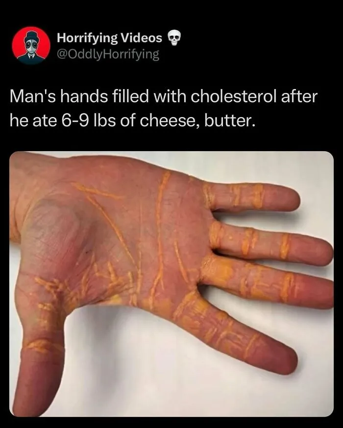 Oddly horrifying image of a man's hand streaked with orange from high cholesterol due to excessive cheese and butter consumption.