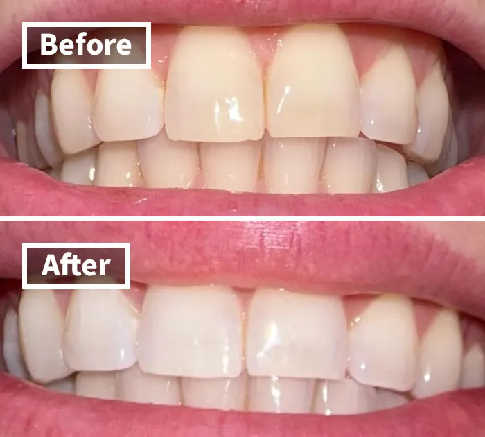 Get Ready For Your Teeth's Personal Glow-Up Sequence With <a Style="Display:inline;" Href="Https://Www.amazon.com/Crest-Professional-Whitestrips-Whitening-Treatments/Dp/B00ahawwo0?ie=utf8&linkcode=ll1&tag=bpsparrow-20&linkid=c08c646561d967ff4c3b0feb22124127&language=en_us&ref_=as_li_ss_tl" Target="_blank"><span Style="Font: Inherit; Color: #d74b1f;"> These Surprisingly Effective Whitening Strips </Span> Because Honestly, Yellow Is So Last Season