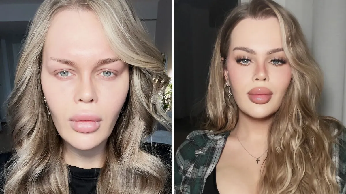 "Now Fix Your Bottom Lip": YouTube Influencer Reveals Gory Eyelid Surgery Aftermath In New Video