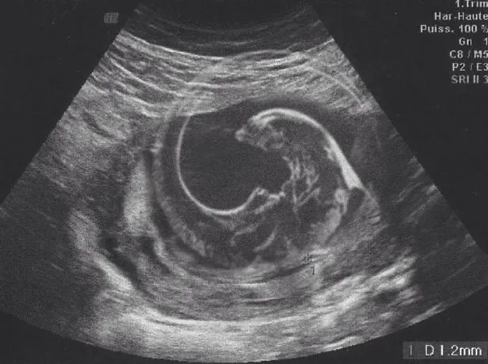 Cuando mi esposa se hizo una ecografía de nuestro primer hijo, tomé una foto de la impresión para que pudiera enviársela a sus amigos y familiares por WhatsApp.