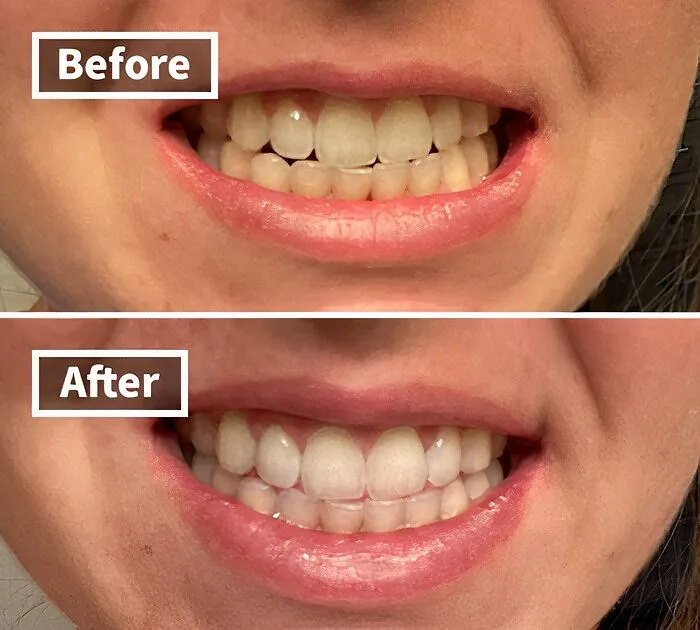 Your Smile Is About To Get A Serious Upgrade In Brightness, Making Your Coffee Habit A Little Less Obvious, Thanks To The <a Style="Display:inline;" Href="Https://Www.amazon.com/Venus-Visage-Effective%ef%bc%86painless-Sensitivity-Travel-Friendly/Dp/B082x2gsgj?ie=utf8&linkcode=ll1&tag=bpbird-20&linkid=dd2219a36b56522c4b16b86b1702e4be&language=en_us&ref_=as_li_ss_tl" Target="_blank"><span Style="Font: Inherit; Color: #d74b1f;"> Venus Visage Teeth Whitening Pen </Span>