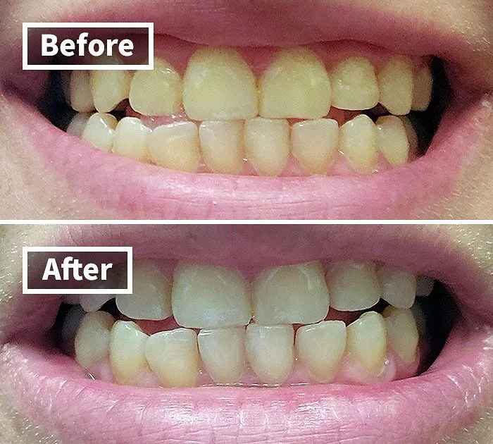 Your Smile Is About To Get A Serious Brightness Boost, Making It The Perfect Accessory For All Those Summer Selfies, Thanks To The Quick And Easy Magic Of This <a Style="Display:inline;" Href="Https://Www.amazon.com/Venus-Visage-Effective%ef%bc%86painless-Sensitivity-Travel-Friendly/Dp/B082x2gsgj?ie=utf8&linkcode=ll1&tag=bpturtle-20&linkid=d0d048d072bf18d4d7d39db2a617aff6&language=en_us&ref_=as_li_ss_tl" Target="_blank"><span Style="Font: Inherit; Color: #d74b1f;"> Teeth Whitening Pen </Span>