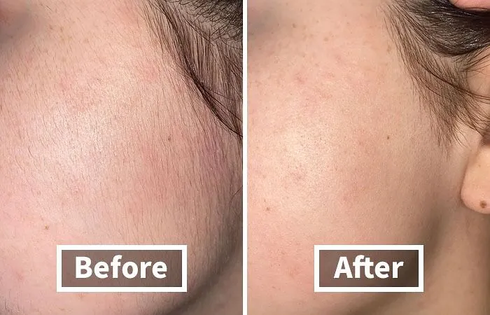 Get Ready For Your Skincare To Actually Sink In And Your Makeup To Glide On Like A Dream After Using This <a Style="Display:inline;" Href="Https://Www.amazon.com/Schick-Multipurpose-Exfoliating-Dermaplaning-Precision/Dp/B0787glbmv?ie=utf8&th=1&linkcode=ll1&tag=bpturtle-20&linkid=efd691310f28d9be7eb8e1cd24051442&language=en_us&ref_=as_li_ss_tl" Target="_blank"><span Style="Font: Inherit; Color: #d74b1f;"> Schick Dermaplaning Tool </Span> To Gently Yeet Away Peach Fuzz And Dull Skin