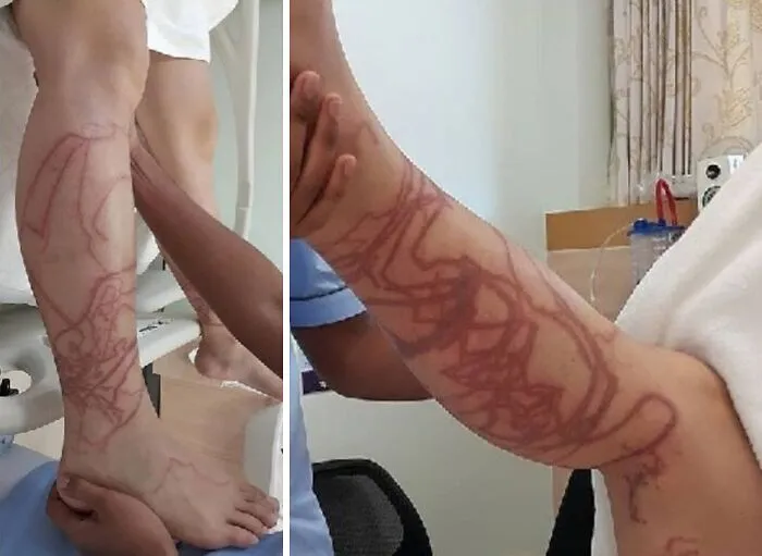 Un hombre chino de 31 años fue picado por una medusa caja con sus múltiples tentáculos en la playa de Chawang, en la isla de Samui, Tailandia.