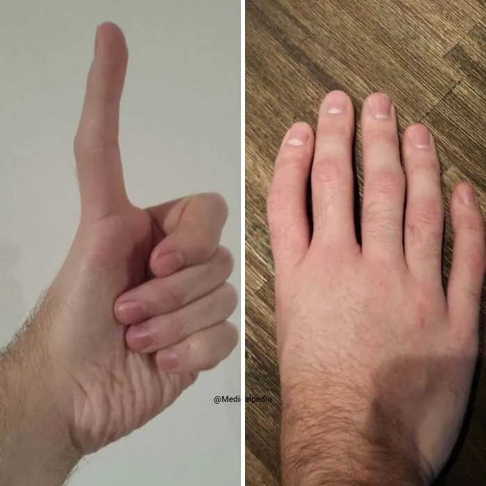 Un caso interesante de pulgar trifalángico