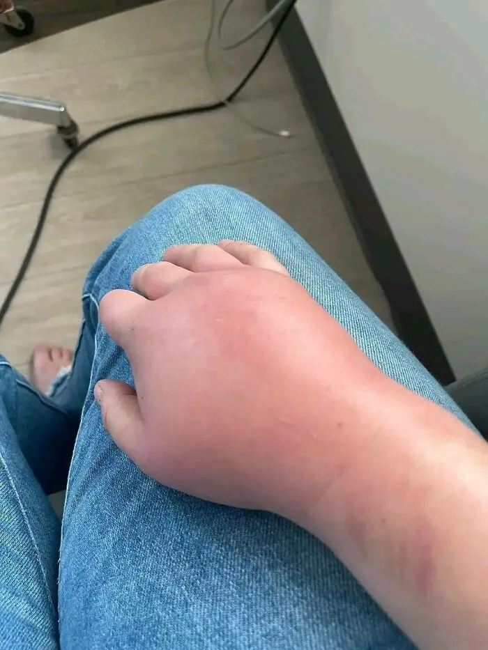 Swollen hand resting on denim jeans, showing an unexpected fail injury that looks painful and unfortunate.