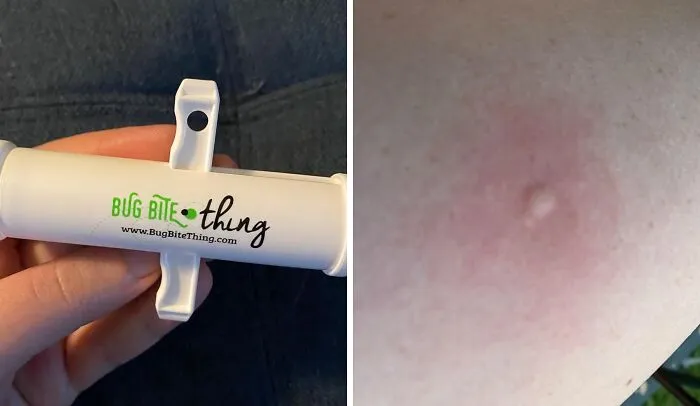 Giving Mosquito Bites The 'Suck It' Treatment Just Became A Very Real, Very Satisfying Option With The<a Style="Display:inline;" Href="Https://Www.amazon.com/Bug-Bite-Thing-Suction-Remover/Dp/B01576dwqu?ie=utf8&th=1&linkcode=ll1&tag=bpcheetah-20&linkid=90030462e965d5c51b9edc22d34da359&language=en_us&ref_=as_li_ss_tl" Target="_blank"> <span Style="Font: Inherit; Color: #d74b1f;"> Bug Bite Thing Suction Tool </Span>