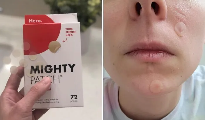 Those Pesky Spots Are About To Feel The Internet-Famous Might Of These <a Style="Display:inline;" Href="Https://Www.amazon.com/Mighty-Patch-Hydrocolloid-Absorbing-Count/Dp/B074pvtpbw?ie=utf8&th=1&linkcode=ll1&tag=bpgoose-20&linkid=62778c37908ada146c82fa3c505ee4c4&language=en_us&ref_=as_li_ss_tl" Target="_blank"><span Style="Font: Inherit; Color: #d74b1f;"> Mighty Patch Pimple Patches </Span>