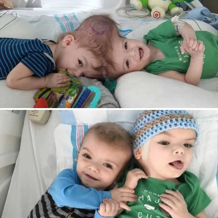 Los siameses Jadon y Anias, fusionados por el cráneo, se separaron con éxito tras una cirugía de 27 horas en 2017