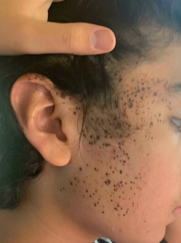 Tengo muchas pecas agrupadas en un solo lado de mi cara