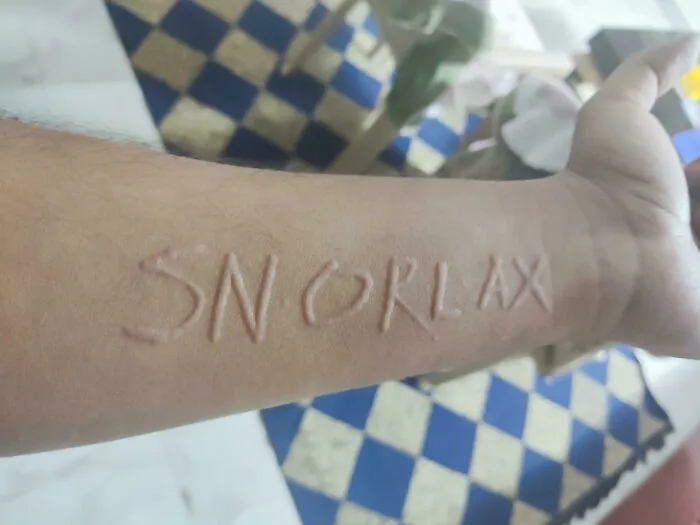 Tengo una afección cutánea llamada dermatografía debido a la cual rascarme ligeramente la piel provoca líneas rojas y elevadas donde me he rascado.