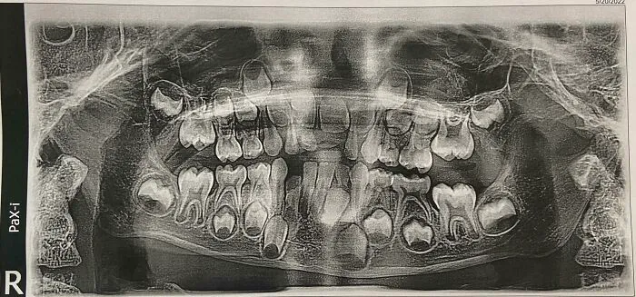 Radiografía dental mostrando estructura ósea y crecimiento de dientes en una imagen interesante del cuerpo humano.