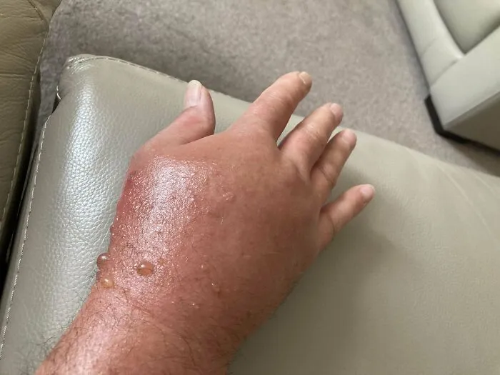 La mano de mi papá después de una picadura de abeja