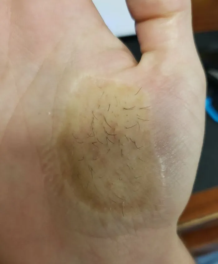 Me crece pelo en la palma de la mano después de un injerto de piel que me hicieron hace unos años