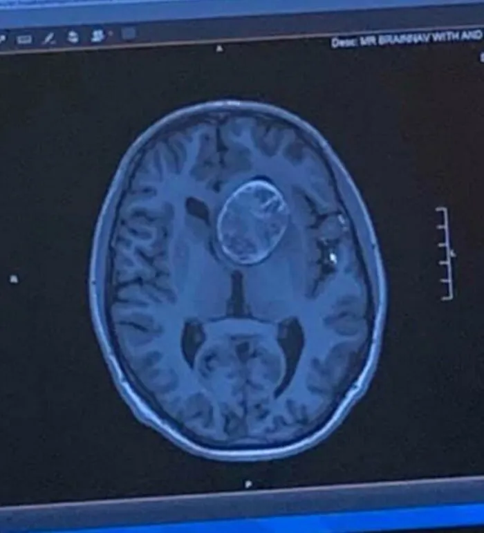 Escáner cerebral y del quiste dermoide de 6,2 cm que me extirparon quirúrgicamente. De alguna manera, mi cerebro logró crecer alrededor de él sin causarme discapacidad física ni mental durante 22 años.