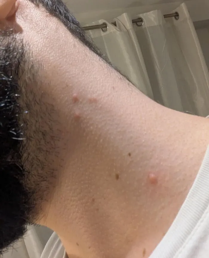 "5 bedbug bites after hotel stay: infestation home now likely?" - <span Style="Font:inherit;color:#808080"> RanVash</Span> 