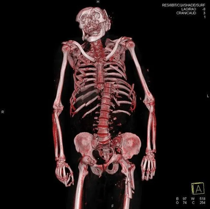 Radiografía 3D de esqueleto humano mostrando estructura ósea, ilustrando fotos médicas que demuestran que el cuerpo puede ser aterrador.