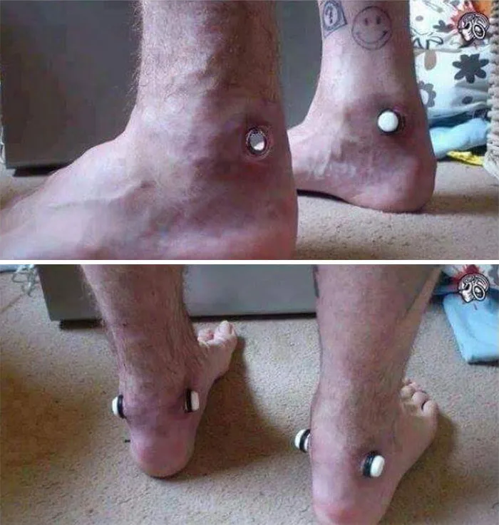 Piernas con imanes insertados en la piel mostrando una imagen médica impactante del cuerpo humano.