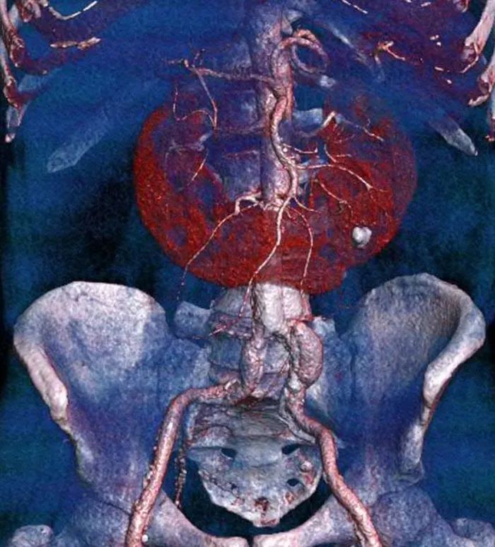 3D scan of human pelvis and arteries revealing unusual anatomy in bizarre and unexpected autopsy discoveries.