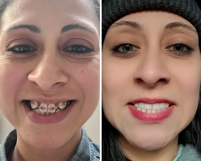 Tras 2 años y 9 meses, al fin sin ortodoncia