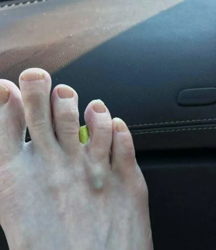 Pie de pie con dedo con deformidad y una protuberancia, imagen médica fascinante y inquietante.