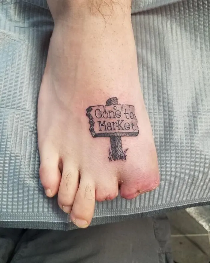 This Is A Case Of A Lawn Mower Accident That Ended Up In Amputation Of The First And Second Toe