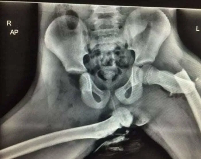 Horrifying X-Ray Shows Why You Should Not Put Your Feet On Car Dashboards