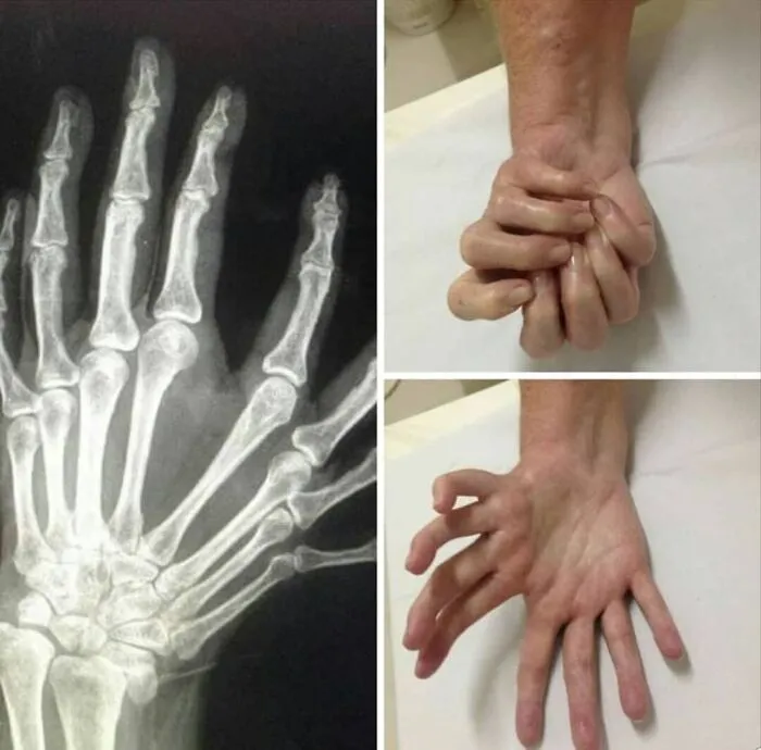 Radiografía y fotos médicas fascinantes de mano con deformidad y movilidad limitada en dedos para análisis clínico detallado.
