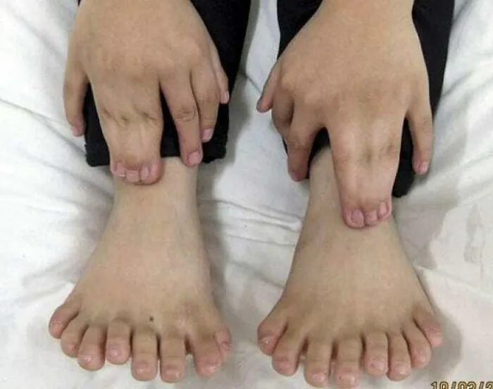 Un caso extremadamente raro de polidactilia de los dedos de los pies con sinpolidactilia de los dedos de las manos